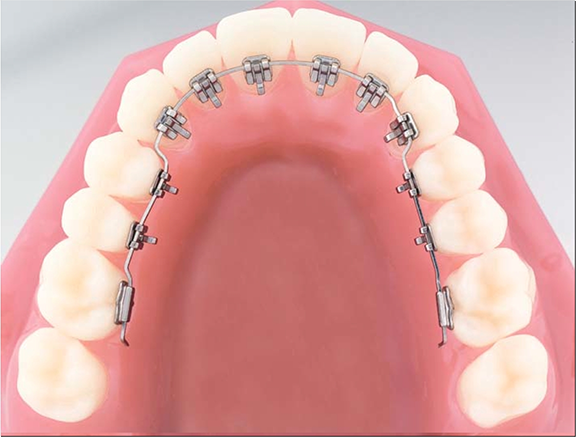 mắc cài mặt lưỡi