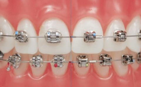Niềng răng có mấy loại