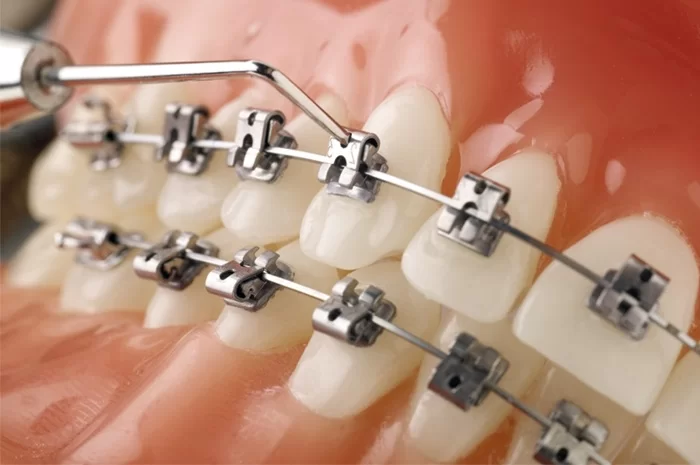 Niềng răng mắc cài kim loại tự buộc