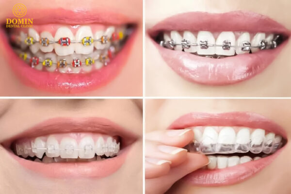 https://nhakhoaident.com/kien-thuc-nha-khoa/nieng-rang-invisalign/