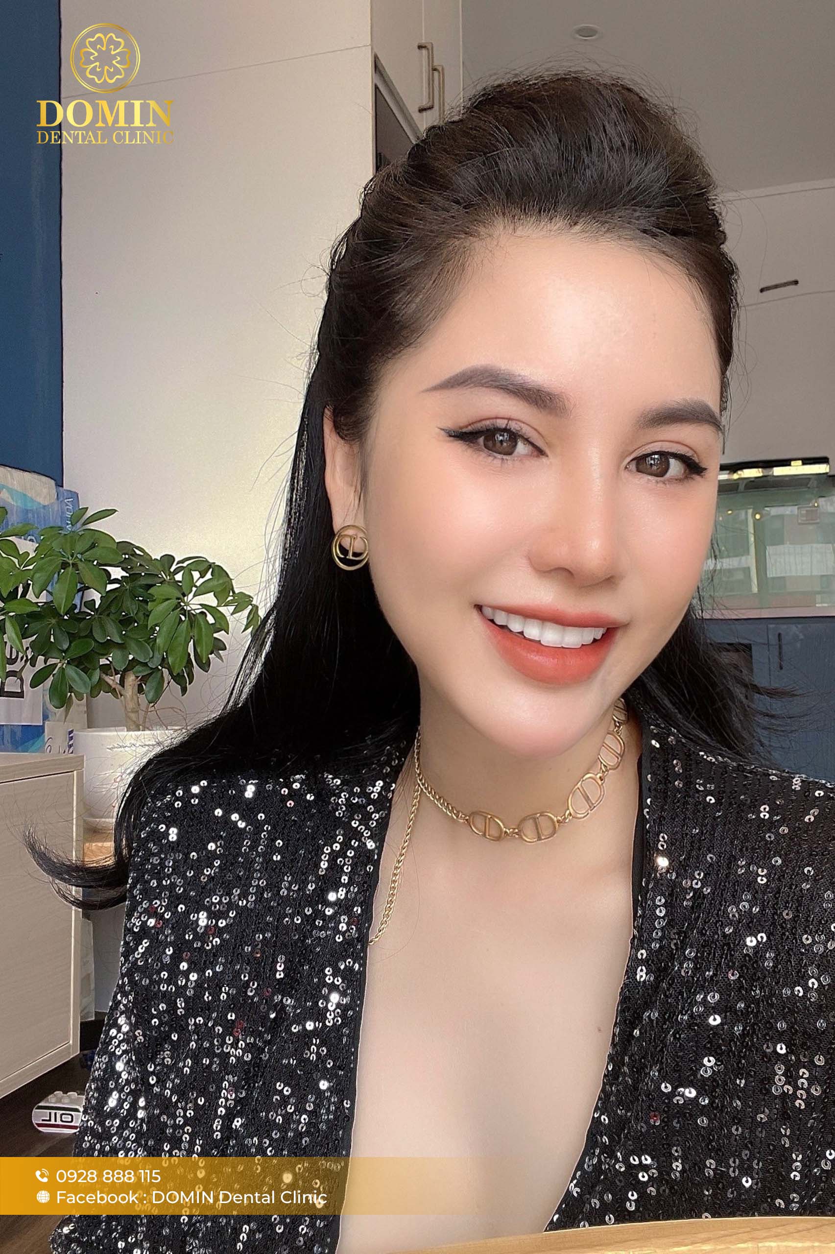 dán sứ Veneer