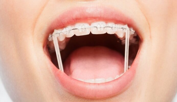 mắc cài niềng răng