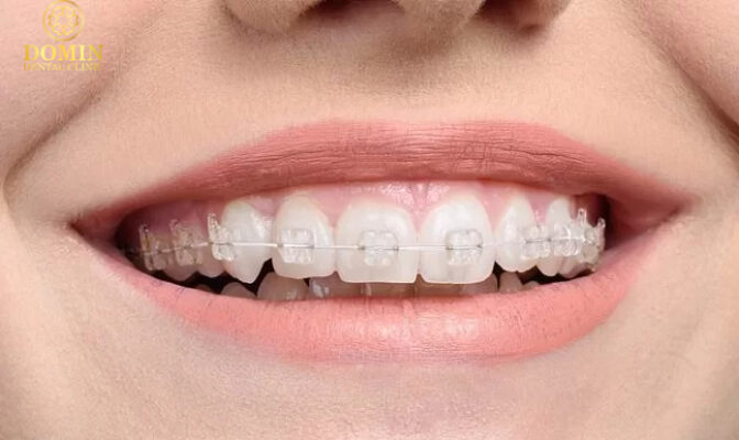 mắc cài niềng răng