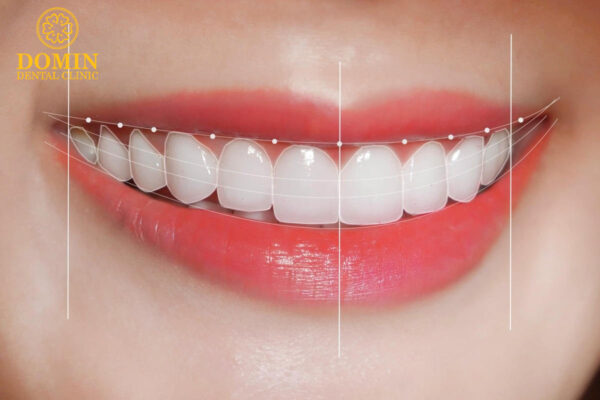 dán sứ Veneer