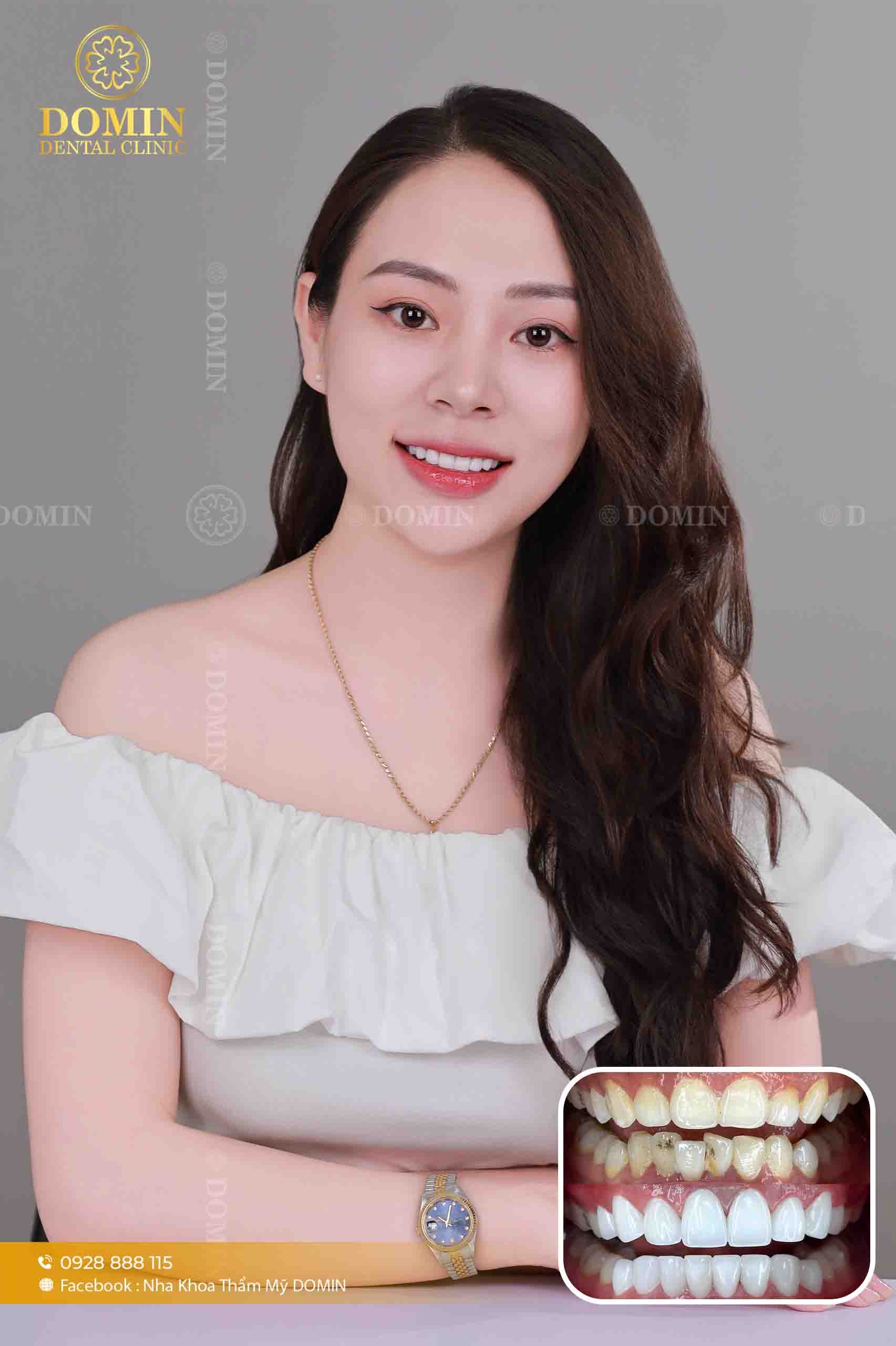 Lý do nên lựa chọn trồng răng Implant thay vì làm cầu răng
