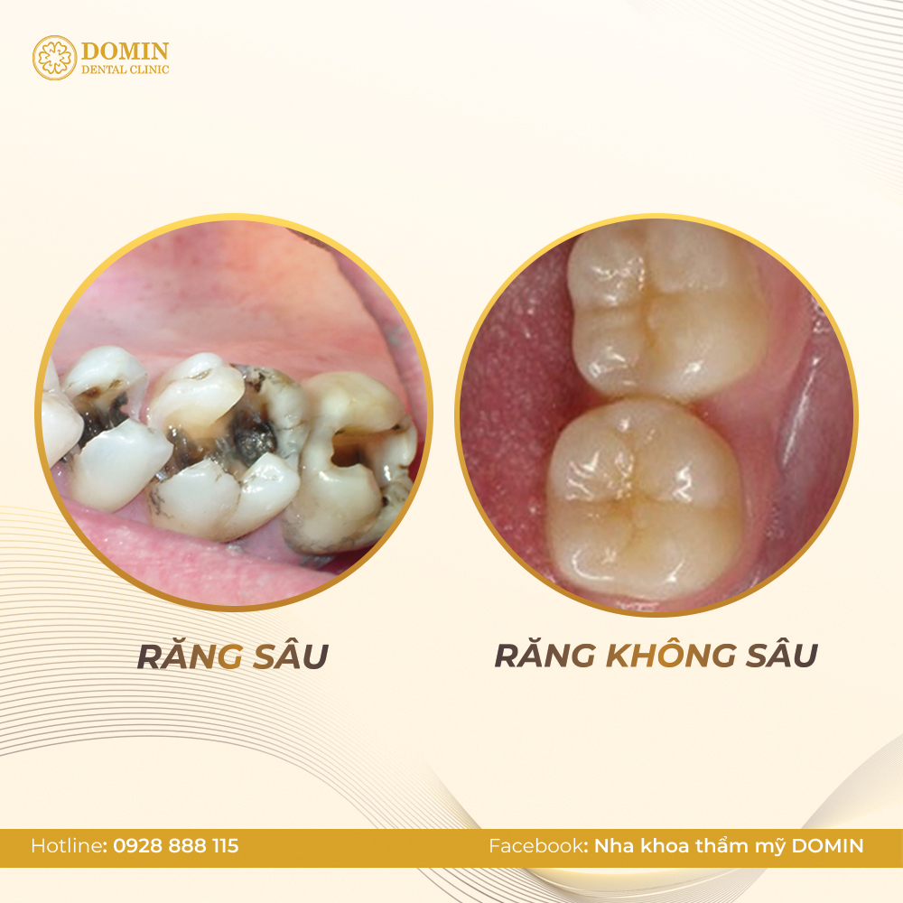 Bọc răng sứ cho răng sâu có được không?