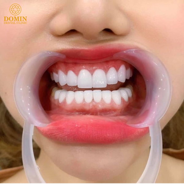Ở hàm dưới nên làm bao nhiêu răng là đẹp nhất?