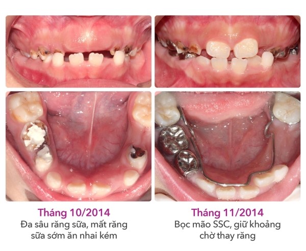 Giải đáp bao nhiêu tuổi thì bọc răng sứ được?
