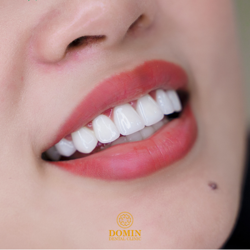 Ưu nhược điểm của bọc răng sứ