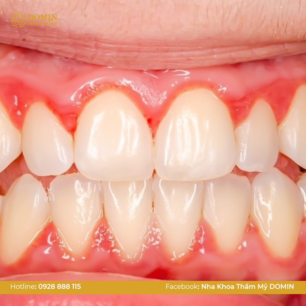 Viền nướu đổi màu - Cảm giác sau khi bọc răng sứ