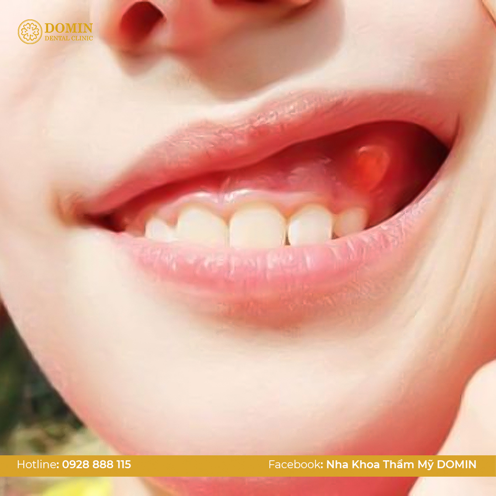 Nướu bị đỏ, thậm chí có mủ